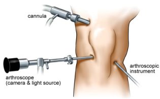 knee-arthroscopy
